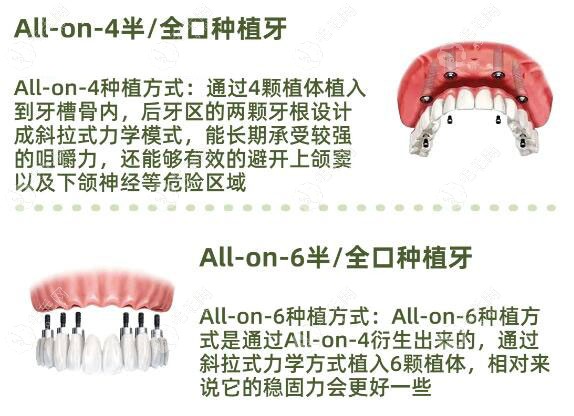 allon6半口固定种植牙靠谱