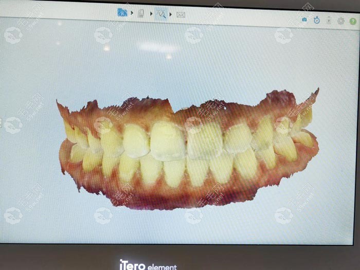 圣琪口腔做牙齿矫正上采用扫描仪预估疗效
