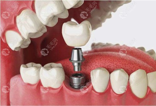 南京固德口腔医院种植牙收费标准