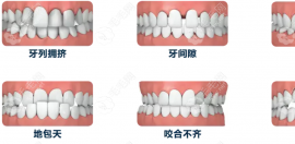 牙齿矫正拔牙4颗有什么危害吗?担心拔了4颗牙收缝收不回去