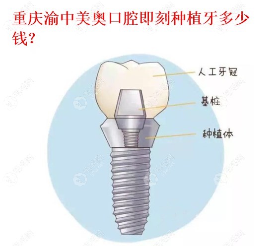 重庆美奥口腔渝中院区即刻种植牙包干价3k,预约电话023685xx66