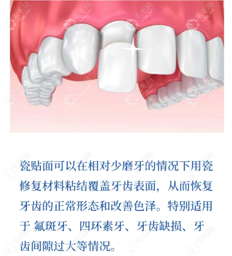 4500一颗的瓷贴面材质好更美观更舒适