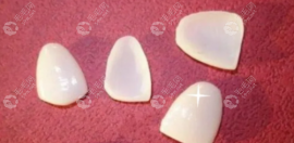 瓷贴面一颗要4500确实有点贵,但瓷贴面材质好更美观更舒适