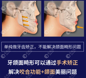 广州广大口腔何锦泉-艾伟建正颌价格4万+