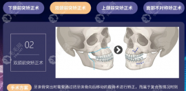 廣州廣大口腔正頜技術(shù)好價(jià)格不貴:找何錦泉-艾偉建正頜4萬+