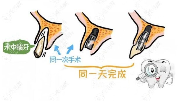 美国皓圣种植体可以即拔即种