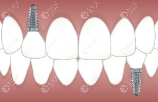 南京雅康口腔种植牙价格多少钱一颗?