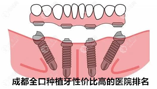 成都全口种植牙性价比高的医院排名:这5家做全口牙价格便宜