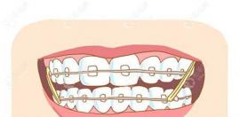 矫正价格表:隐形牙齿矫正费用2.5w