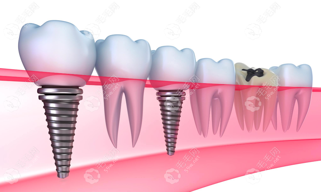 种植牙价格贵但是使用寿命长www.59w.net