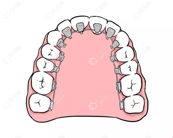 舌侧矫正器品牌