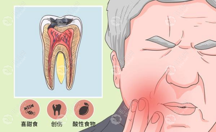 牙髓炎治疗费用大概多少钱?急性牙髓炎根管治疗费1k+能报销