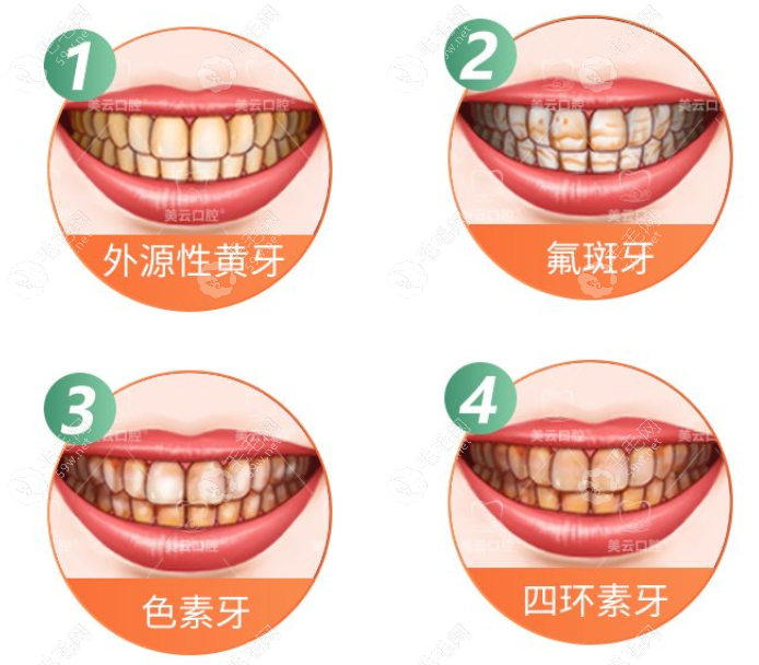 广州曙光口腔冷光美白1430元起