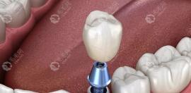 郑州种植牙比较好的口腔医院排名前三是唯美、德韩、植得