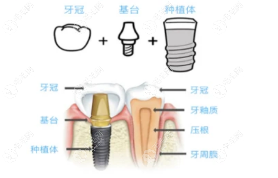 太原皓雅口腔种植牙价格