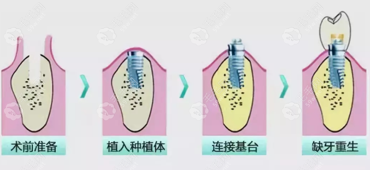 种植牙过程和步骤图解