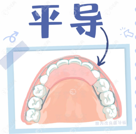 平导矫正器是什么