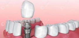 3000元的种植牙寿命是10-20年左右，选正规品牌植体也很可靠