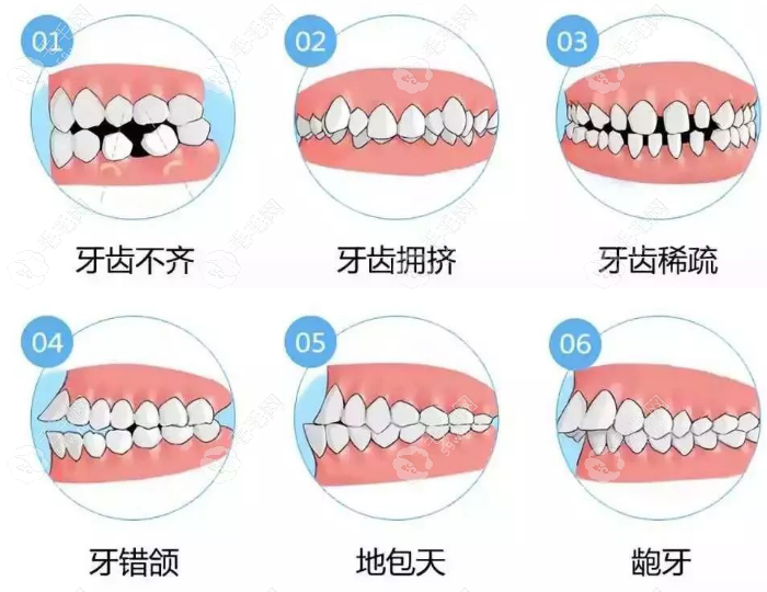 25-30矫正牙齿要花多少钱和时间?隐形正畸15000元起要1-2年时间