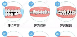 25-30矫正牙齿要花多少钱和时间?隐形正畸15000元起要1-2年时间