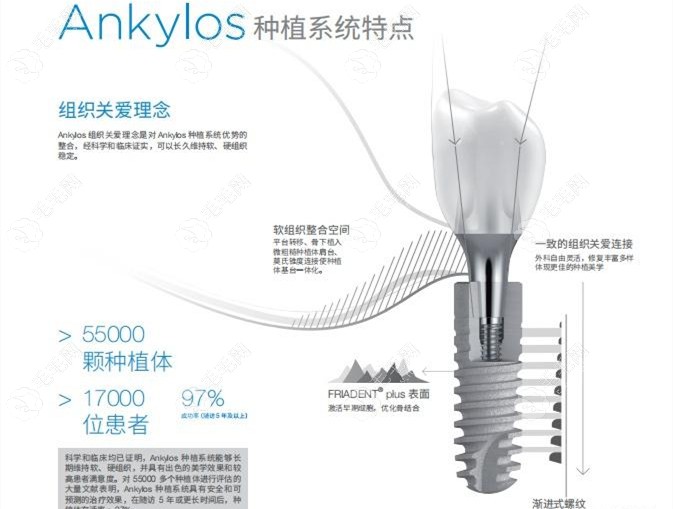 的德国费亚丹种植体多少钱和所采用型号有关www.59w.net