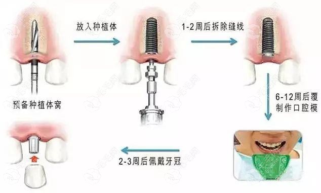 德国费亚丹种植体的种植原理