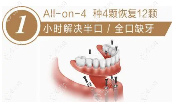 all-on-4全口种植韩国牙价格多少钱