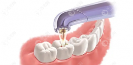 大牙裂成了两半必须拔掉吗?如果不疼也没掉下来可以先修复