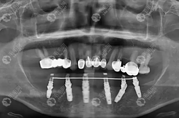 全口半固定种植牙技术的优点~毛毛网