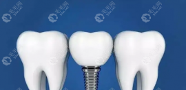 东莞全口种植牙价钱一般3.8w~15w元起,居然差10w之多是为啥