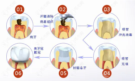 根管治疗的过程