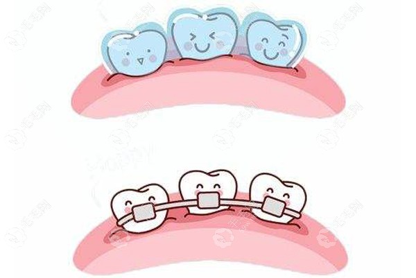 公布哈尔滨牙齿矫正价格多少钱:金属牙套比隐形矫正便宜5k+