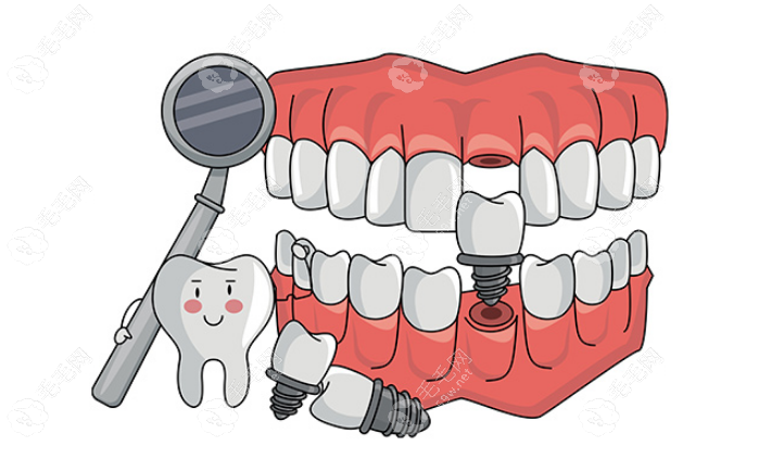 永川牙博士口腔种植牙价格表