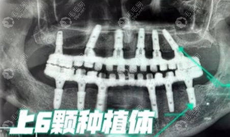 种植6颗牙上口方案