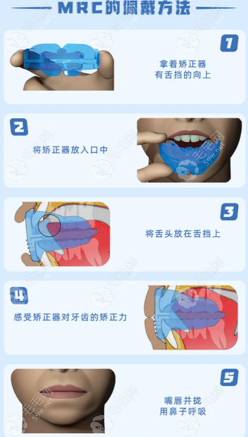 佩戴MRC矫正器的方式