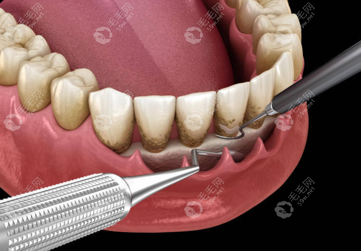 全口牙周炎症状以及治疗措施~毛毛网
