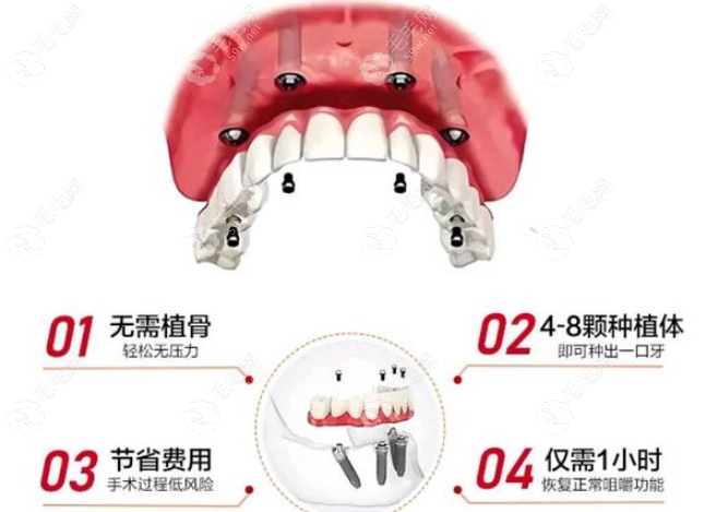 艺星口腔半口种植牙技术 毛毛网