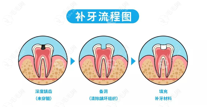 补牙3m树脂