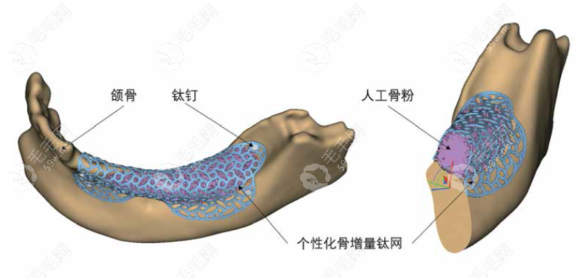 骨增量手术的“三板斧”