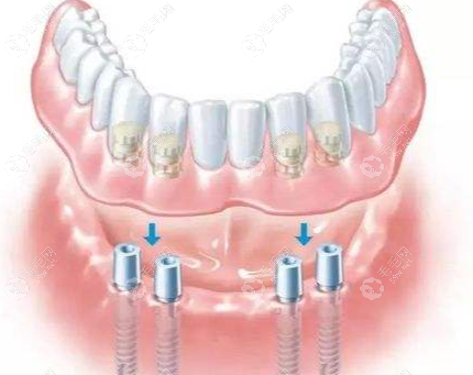 上海美奥口腔种植牙便宜又好