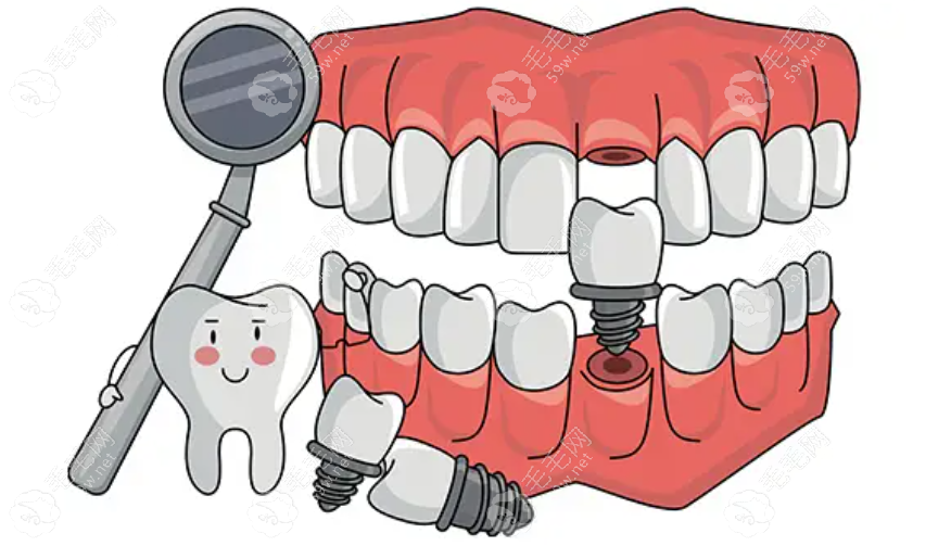 种植牙一颗多少钱2024价格表