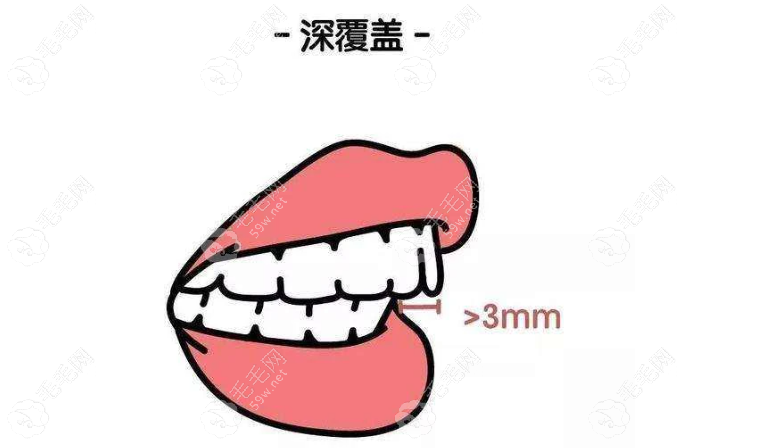 拔牙带牙套1~12月变化图片 毛毛网