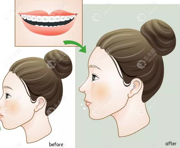 戴牙套一年脸型的变化图片