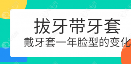 图文见证:拔牙带牙套1~12月脸型变化大,成功矫正了门牙外凸