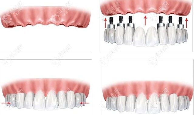 all-on-6种植牙