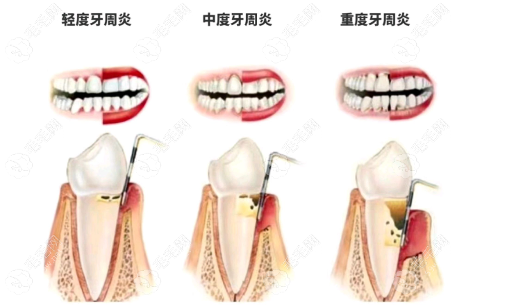 40岁牙周炎牙