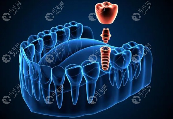 宝山种植牙哪个医院种得好59w.net