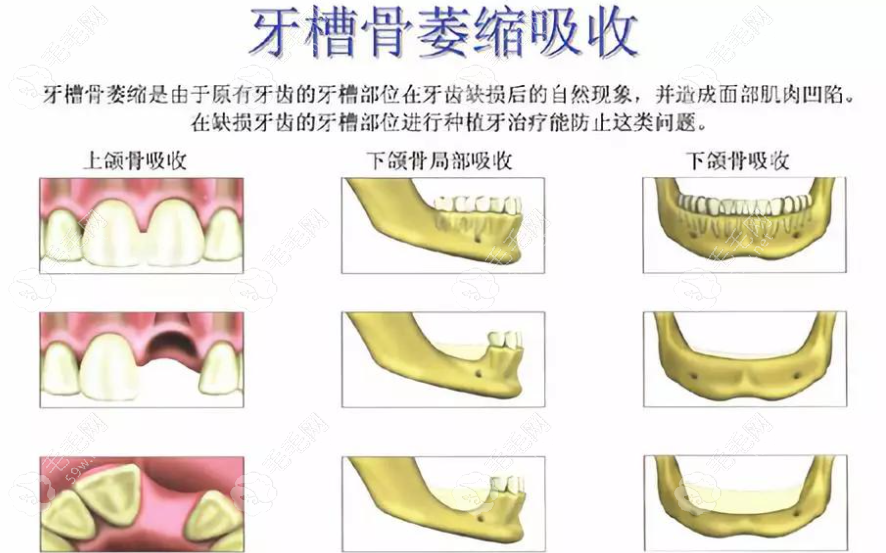 牙槽骨萎缩较重种牙