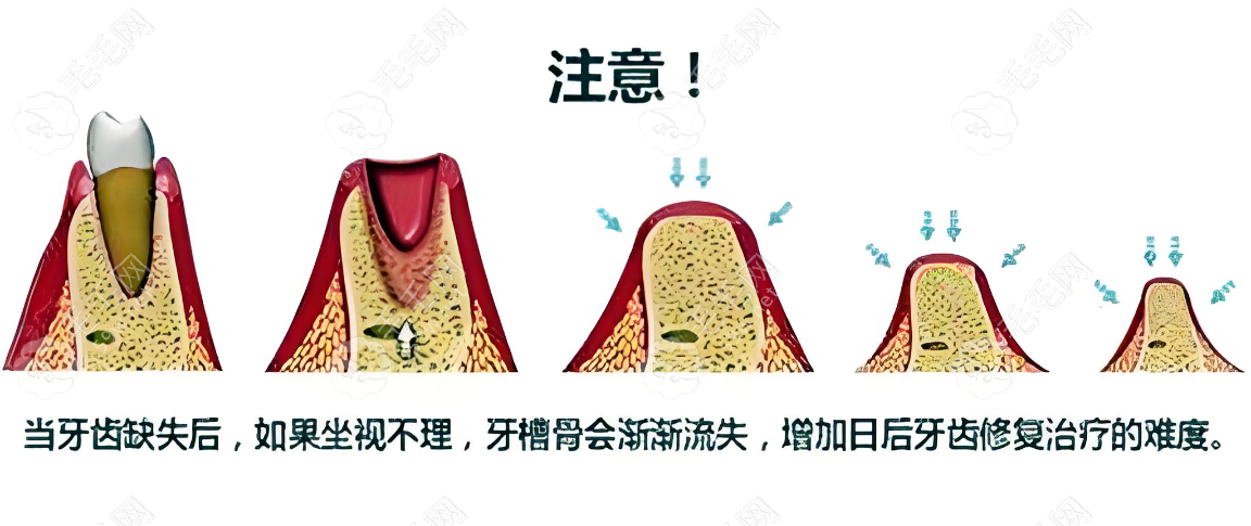 牙齿较重萎缩