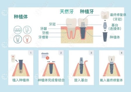 沈阳九诺口腔种植牙做得好